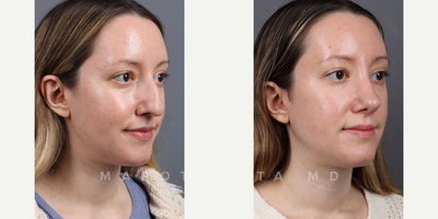 Case 4111 - Woman treated with Rhinoplasty