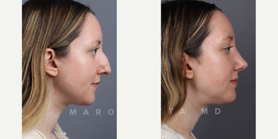 Case 4112 - Woman treated with Rhinoplasty