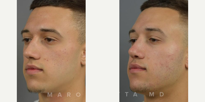 Case 4113 - Man treated with Rhinoplasty