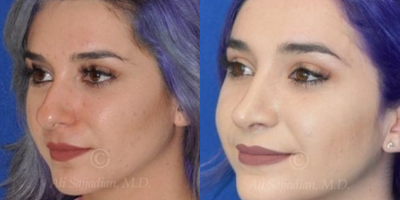 Case 4114 - Woman treated with Rhinoplasty