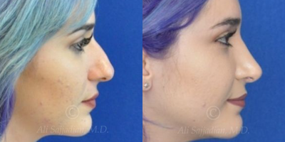 Case 4115 - Woman treated with Rhinoplasty