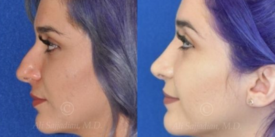 Case 4116 - Woman treated with Rhinoplasty