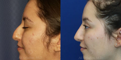 Case 4117 - Woman treated with Rhinoplasty