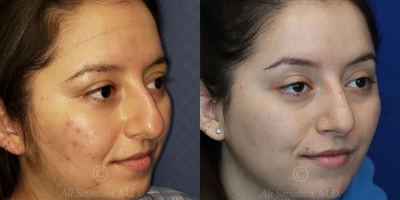Case 4118 - Woman treated with Rhinoplasty