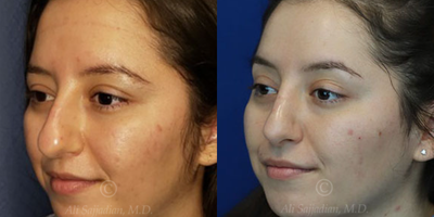 Case 4119 - Woman treated with Rhinoplasty