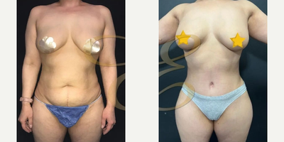 Case 412 - Woman treated with Tummy Tuck