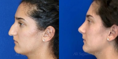 Case 4120 - Woman treated with Rhinoplasty
