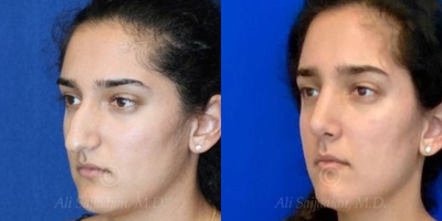 Case 4121 - Woman treated with Rhinoplasty