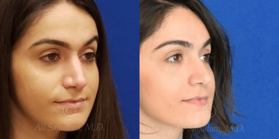 Case 4122 - Woman treated with Rhinoplasty