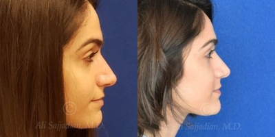 Case 4123 - Woman treated with Rhinoplasty