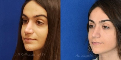Case 4124 - Woman treated with Rhinoplasty