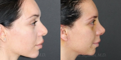 Case 4125 - Woman treated with Rhinoplasty