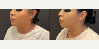 Case 4126 - Woman treated with Rhinoplasty