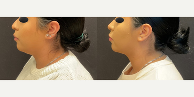 Case 4127 - Woman treated with Rhinoplasty