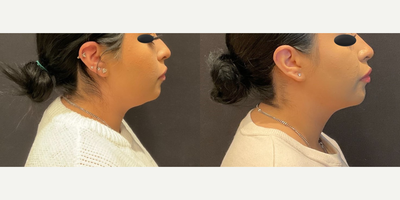 Case 4128 - Woman treated with Rhinoplasty