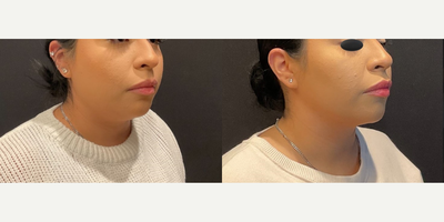 Case 4129 - Woman treated with Rhinoplasty