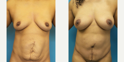 Case 413 - Woman treated with Tummy Tuck