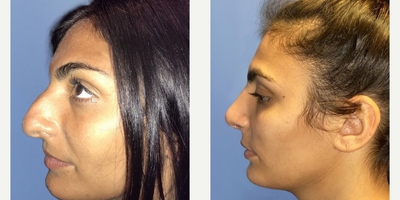 Case 4130 - Woman treated with Rhinoplasty