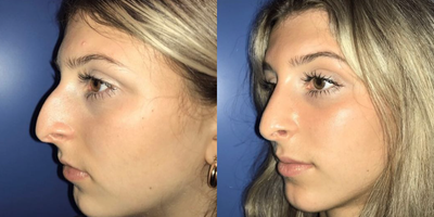 Case 4132 - Woman treated with Rhinoplasty