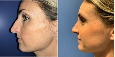 Case 4133 - Woman treated with Rhinoplasty