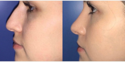 Case 4134 - Woman treated with Rhinoplasty