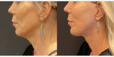 Case 4135 - Woman treated with Rhinoplasty