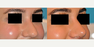 Case 4136 - Woman treated with Rhinoplasty