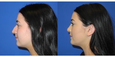 Case 4138 - Woman treated with Rhinoplasty