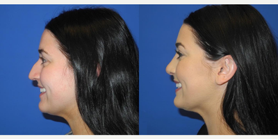 Case 4139 - Woman treated with Rhinoplasty