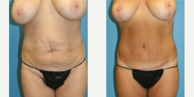 Case 414 - Woman treated with Tummy Tuck