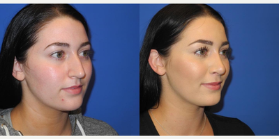 Case 4140 - Woman treated with Rhinoplasty