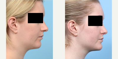 Case 4141 - 18-24 year old woman treated with Rhinoplasty