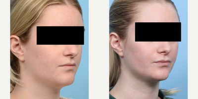 Case 4142 - 18-24 year old woman treated with Rhinoplasty