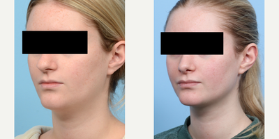 Case 4143 - 18-24 year old woman treated with Rhinoplasty