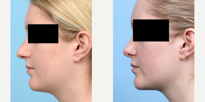 Case 4144 - 18-24 year old woman treated with Rhinoplasty