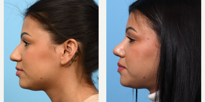 Case 4145 - 25-34 year old woman treated with Rhinoplasty
