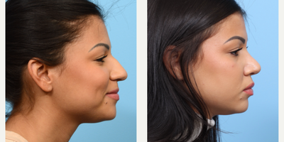 Case 4146 - 25-34 year old woman treated with Rhinoplasty