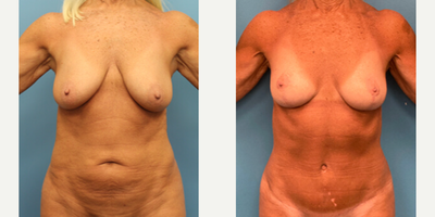 Case 415 - Woman treated with Tummy Tuck