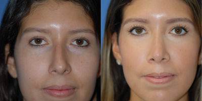 Case 4155 - 18-24 year old woman treated with Rhinoplasty