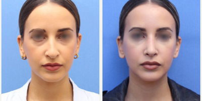 Case 4156 - Woman treated with Nose Surgery