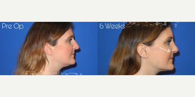 Case 4157 - Woman treated with Rhinoplasty