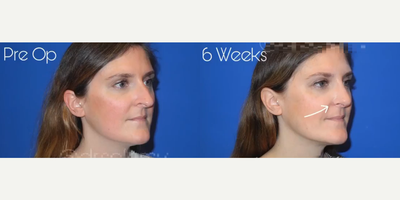 Case 4158 - Woman treated with Rhinoplasty