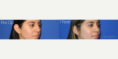 Case 4159 - Woman treated with Rhinoplasty