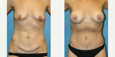 Case 416 - Woman treated with Tummy Tuck