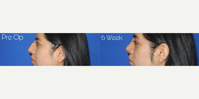 Case 4160 - Woman treated with Rhinoplasty