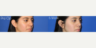 Case 4161 - Woman treated with Rhinoplasty