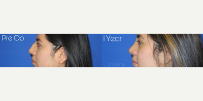 Case 4162 - Woman treated with Rhinoplasty