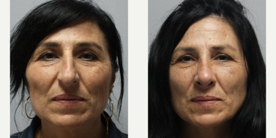 Case 4163 - Woman treated with Rhinoplasty
