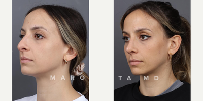 Case 4164 - Woman treated with Rhinoplasty