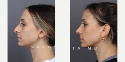 Case 4165 - Woman treated with Rhinoplasty